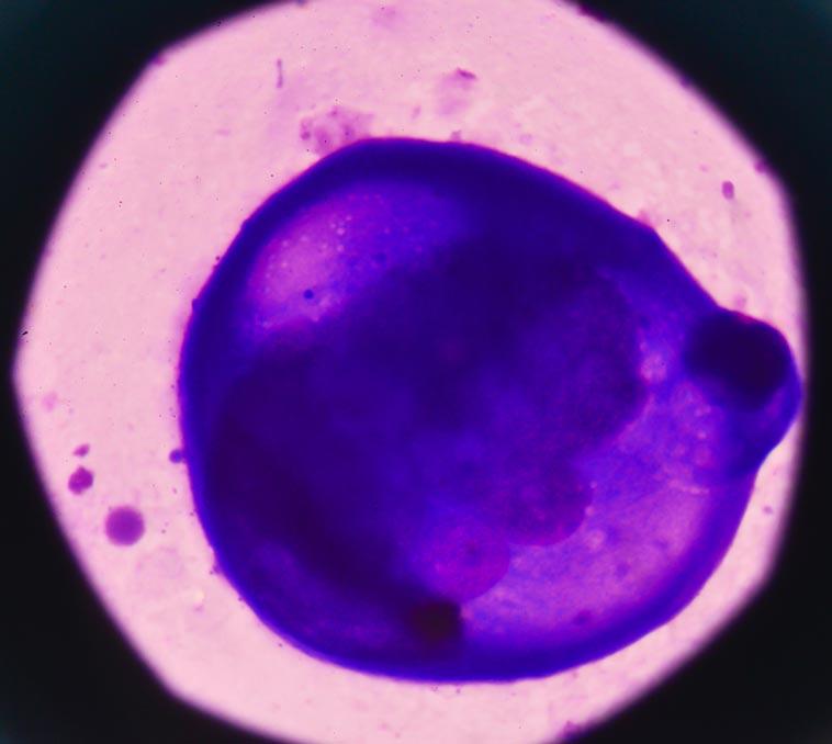 Abnormale Malignen Zellen