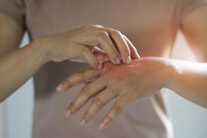 FRau kratzt sich ihre Hand wegen Pilzbefall