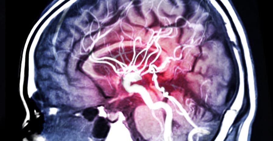 Magnetresonanzangiographie von einem Gehrin