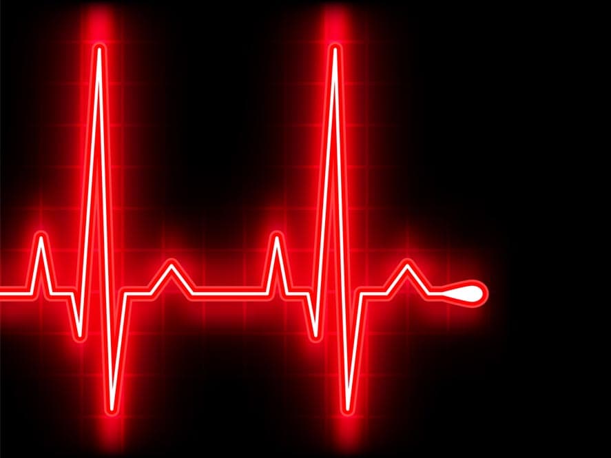 EKG Diagramm