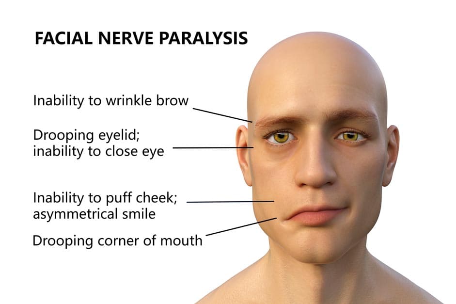 Menschliche Illustration mit Fazialisparese
