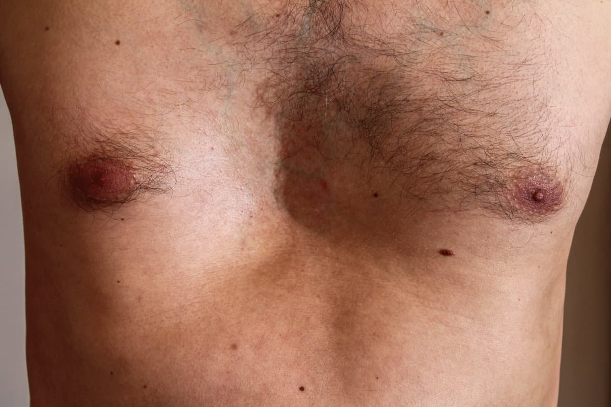 Chest deformity, birth defect. Strong deformity. pectus excavatus