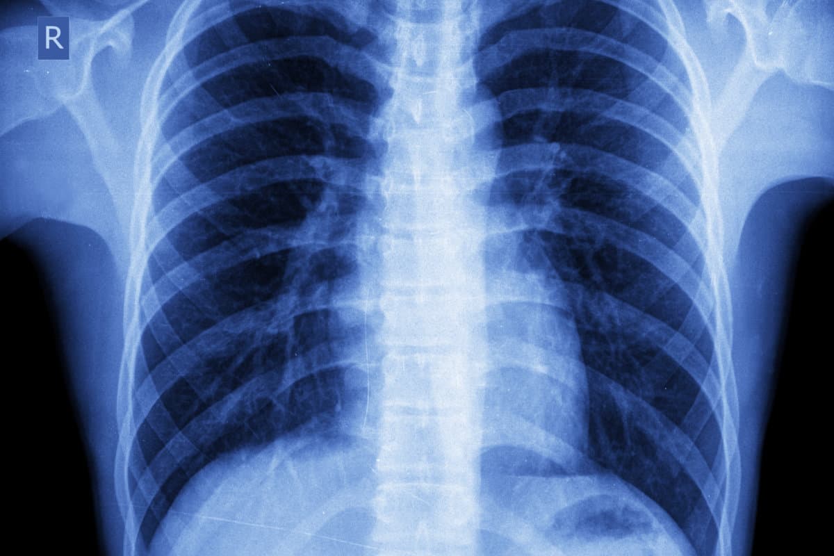 x-ray chest