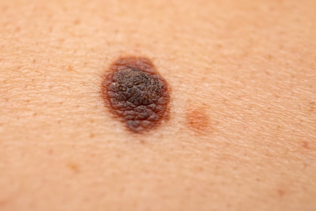 Close up picture of dangerous brown nevus on human skin - melanoma