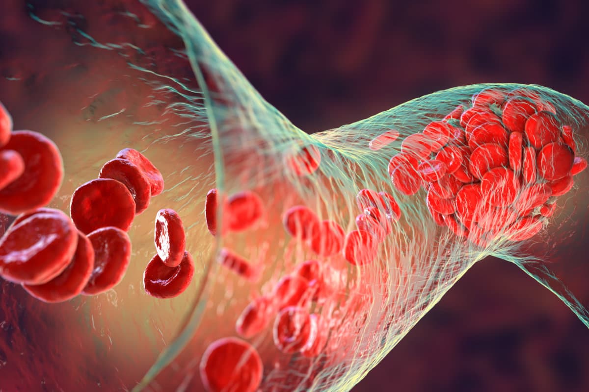 Blutgerinnsel aus roten Blutkörperchen, Blutplättchen und Fibrinproteinsträngen. Thrombus, 3D-Illustration