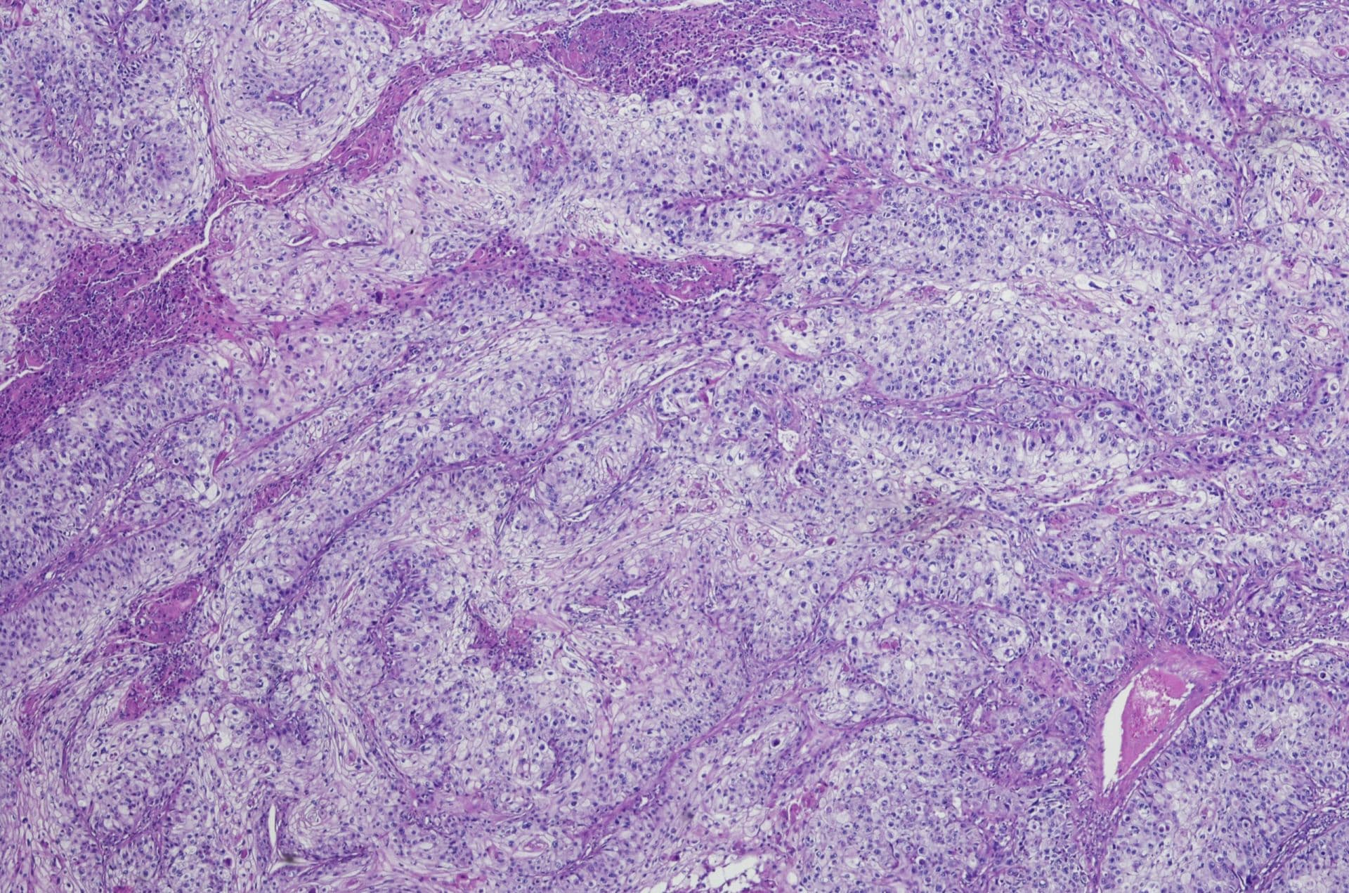 Micrograph of squamous cell carcinoma of the head and neck