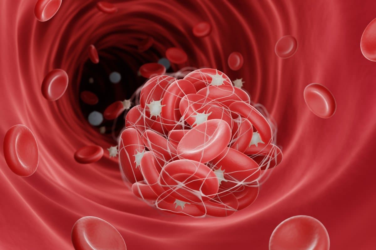 Blood clot illustration, Thrombosis is a dangerouse disease whic