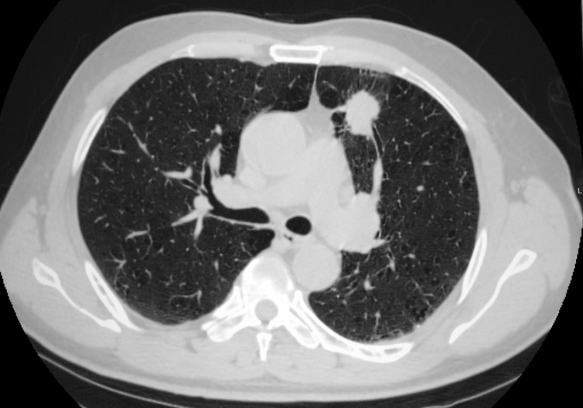 lung cancer thorax CT image