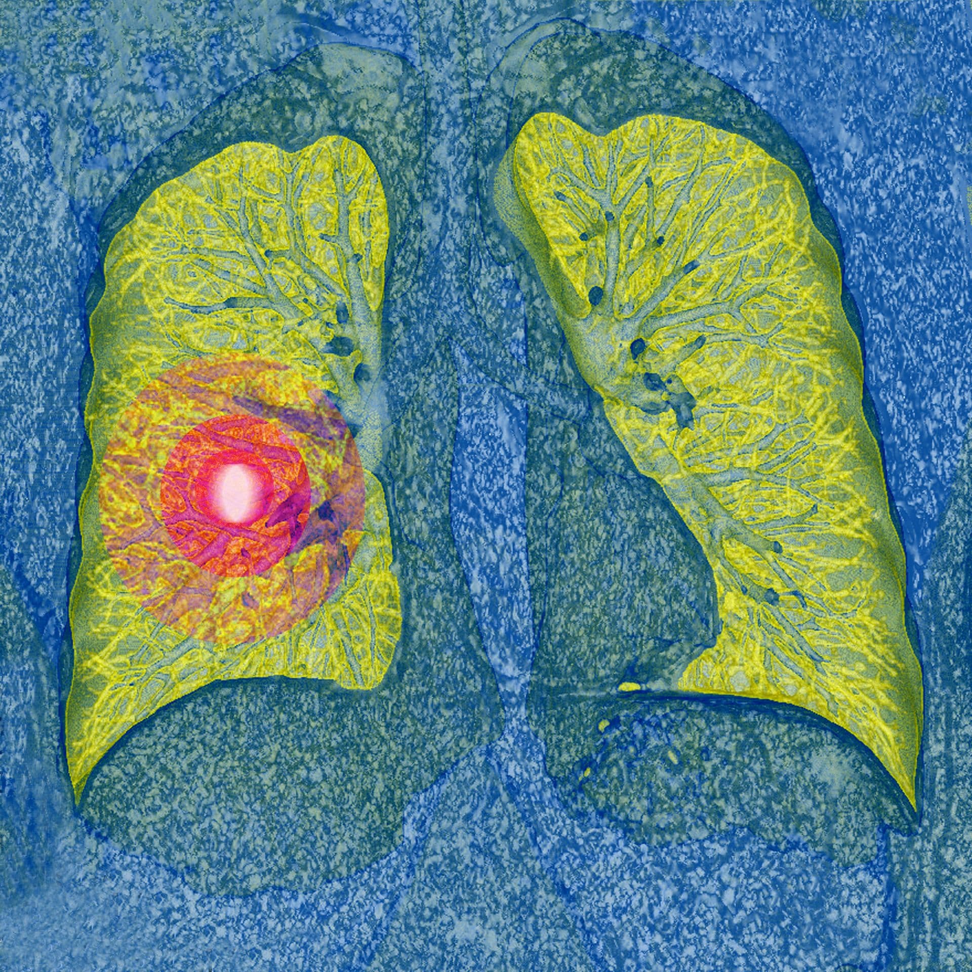 Lung cancer, CT