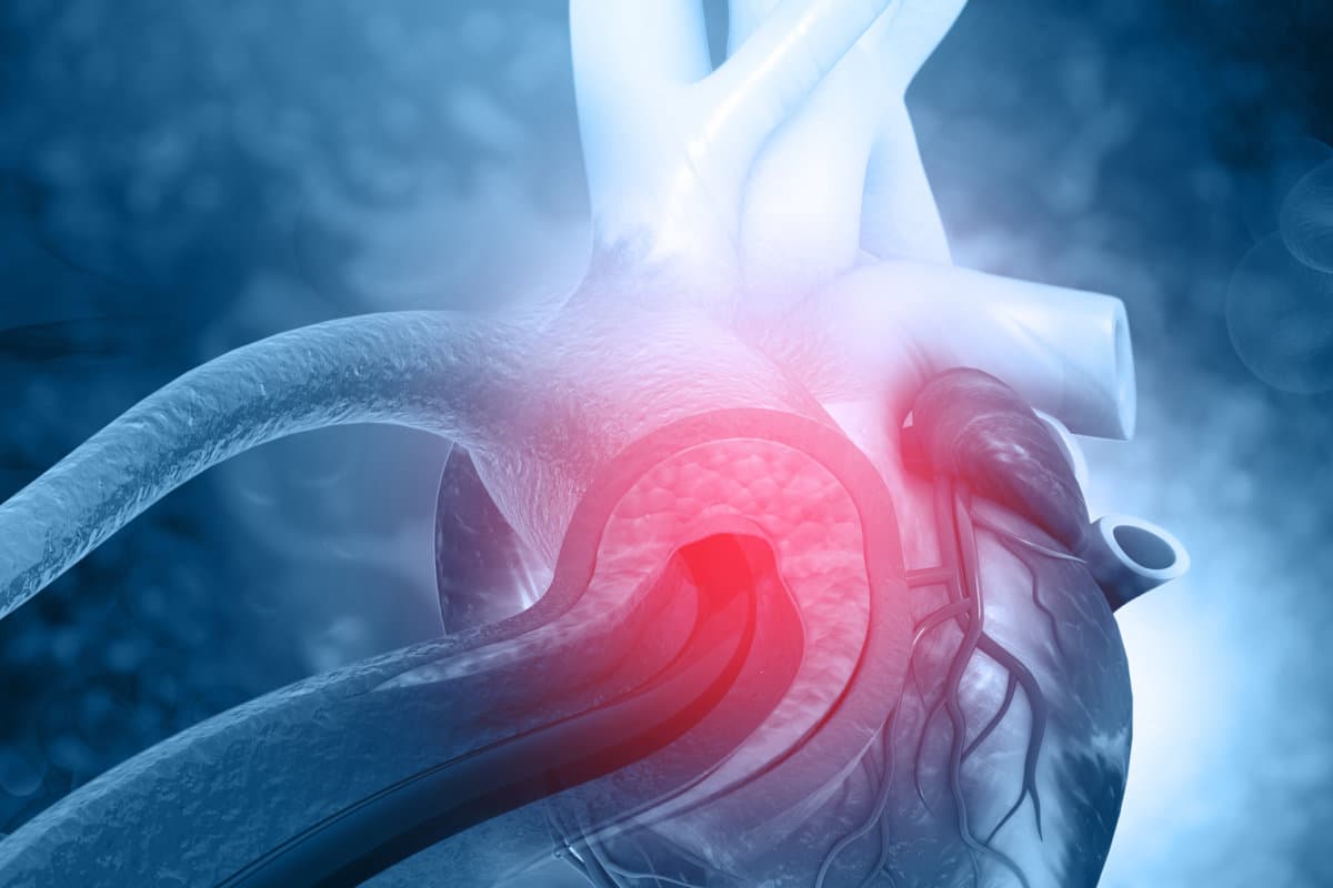 Angioplastie des menschlichen Herzens. 3D-Illustration
