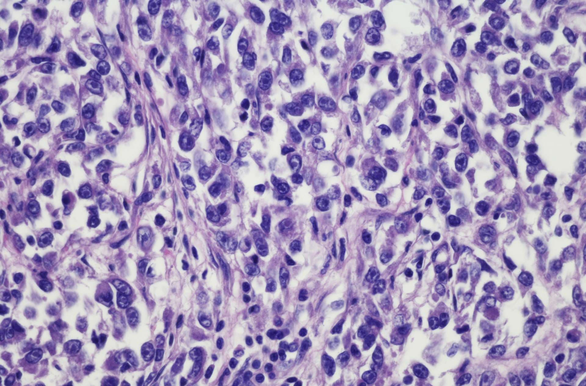 Clear cell sarcoma of the leg