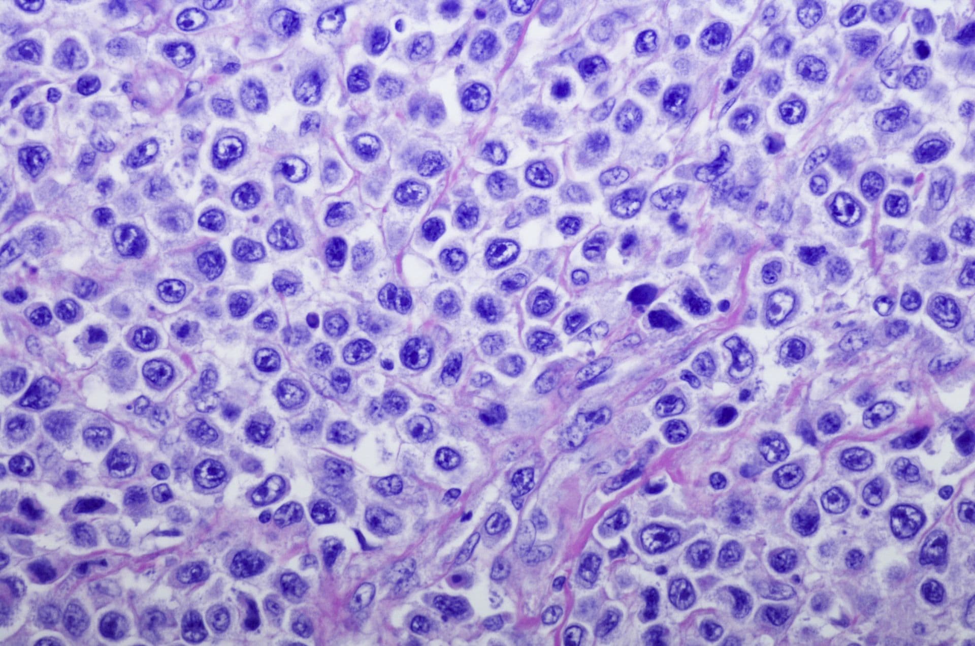 Primäres kutanes großes B-Zell-Lymphom