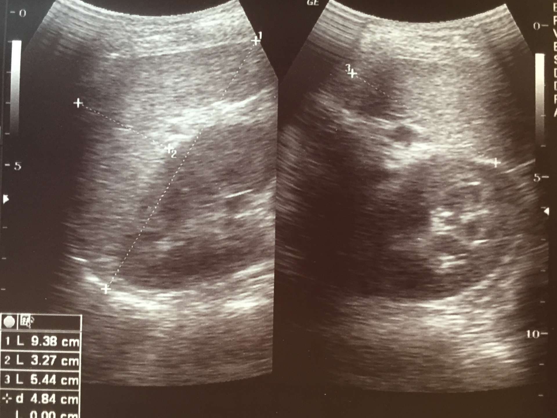Sonographisches Bild von Milz und Niere
