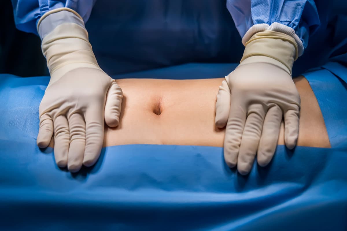 Abdomen prepare for abdominal surgery with sterile drape.Surgeon or nurse in blue uniform put hands with glove on patient.Abdominal surgery inside operating room in hospital.Hernia repair surgery.