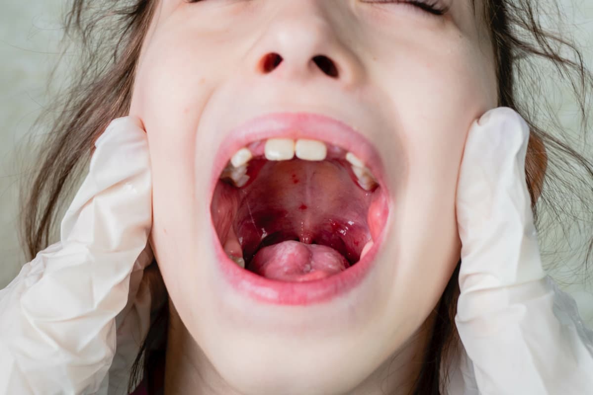 pediatrician doctor in medical gloves examines the child's sore throat with herpes sore throat