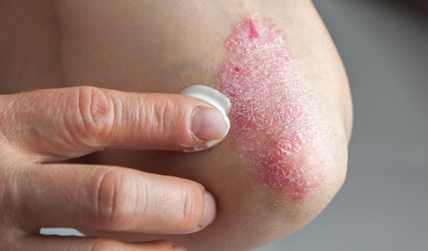 Bei Psoriasis kann gute Pflege die Hautbarriere stärken.