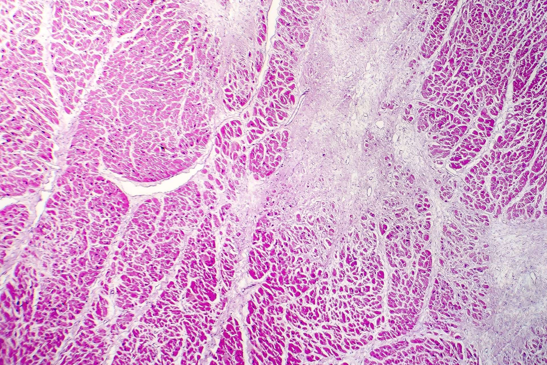 Akuter Myokardinfarkt, Histologie des Herzgewebes, lichtmikroskopische Aufnahme