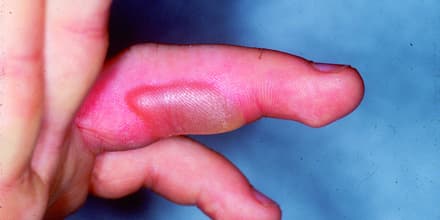 Abb2_Staphylokokken-Infekt-nach-Stichverletzung_440x220