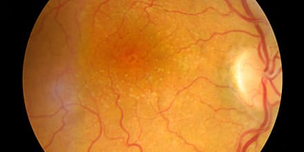 Medical Fundus photo of retinal pathology, hemmorhages, vein occ