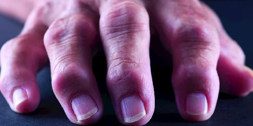 Handarthrose_iStock_rudisill