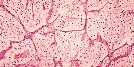 Nierenzellkarzinom_cdc_20G0035_lores