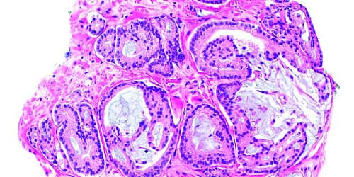 Prostatakarzinom_wikimedia_Nephron