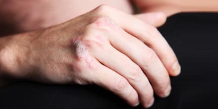 Psoriasis_28603359_Farina3000_Fotolia_04