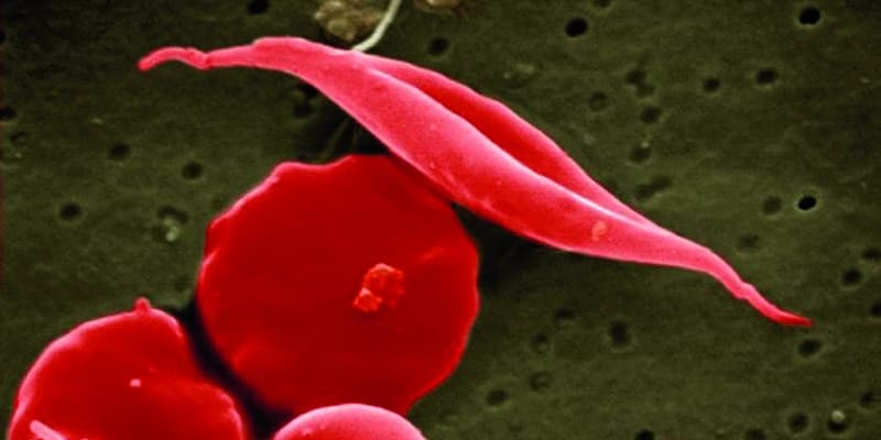 Sichelzellanaemie