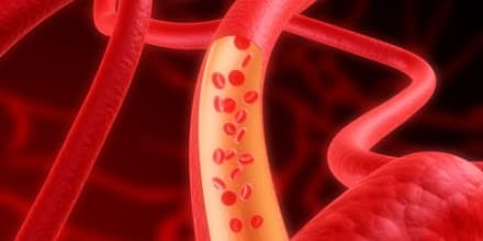 Thrombophlebitis_th_115984845_02
