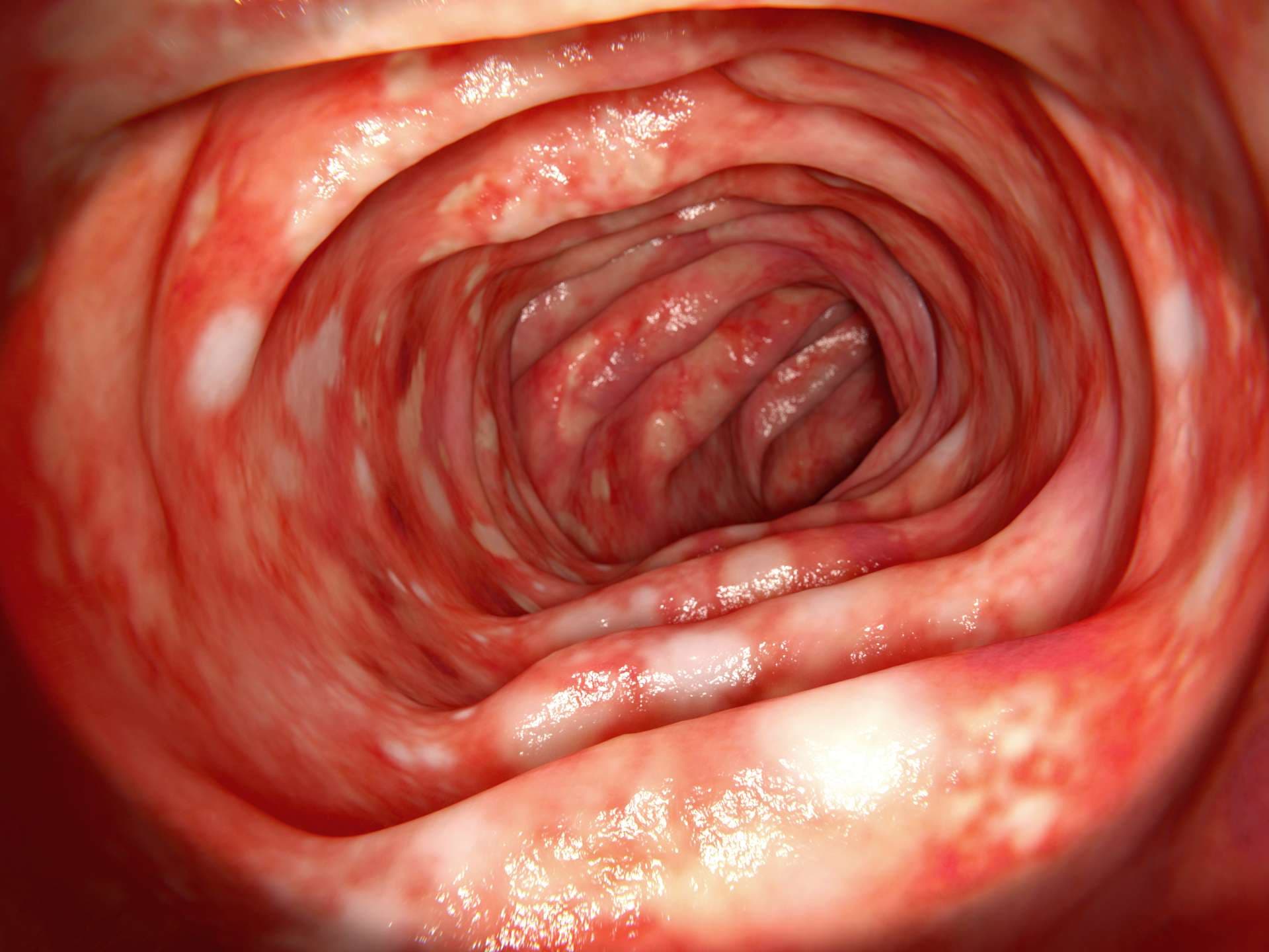 The ulcerative colitis is an inflammatory disease of the human bowel.