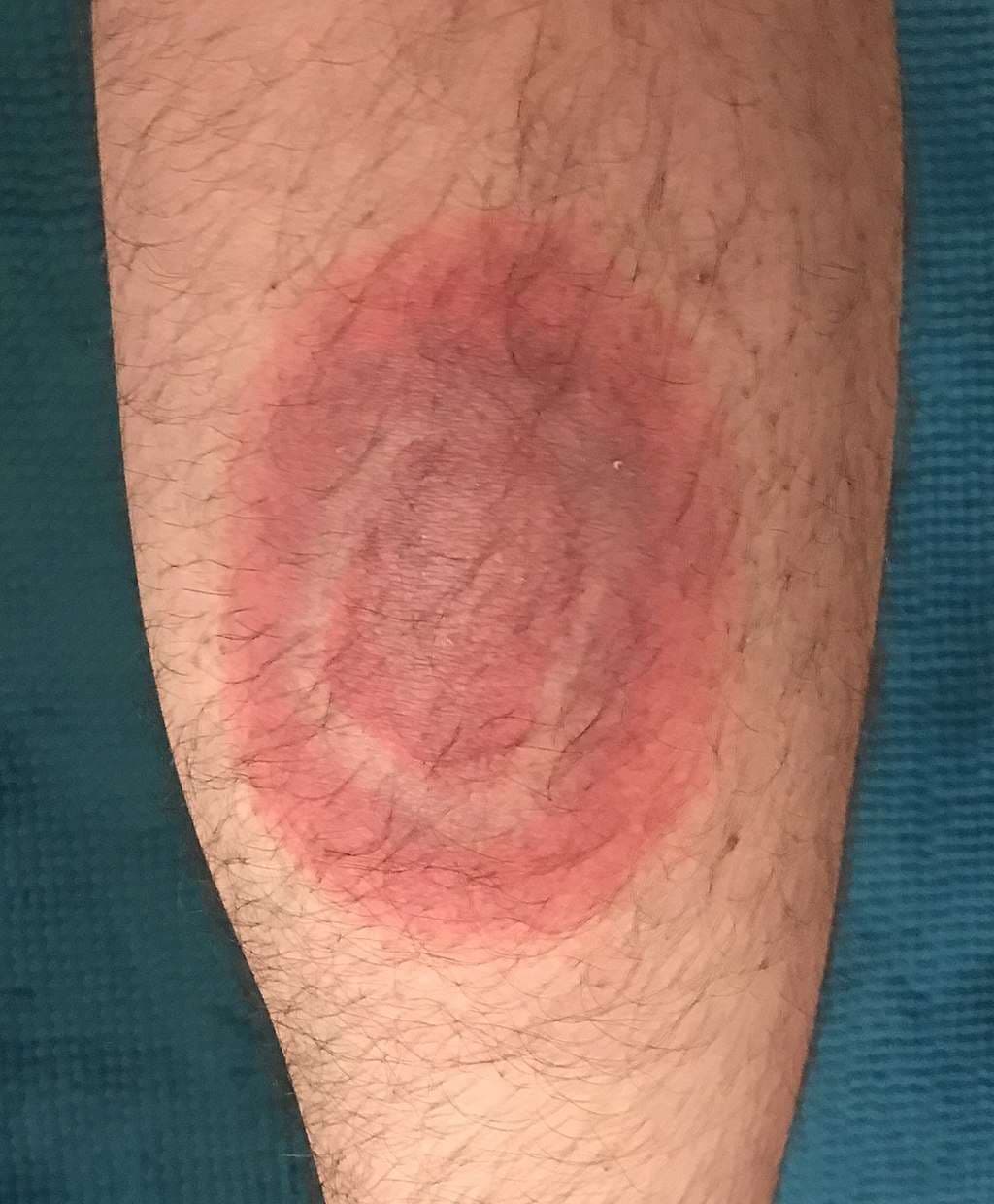 Die Wanderröte kann ein Hinweis auf eine beginnende Borreliose sein.