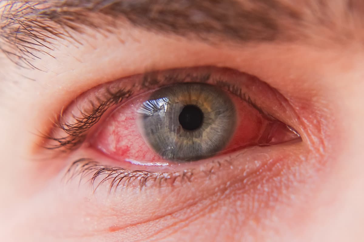 Macro close up of red eye with conjunctivitis infection