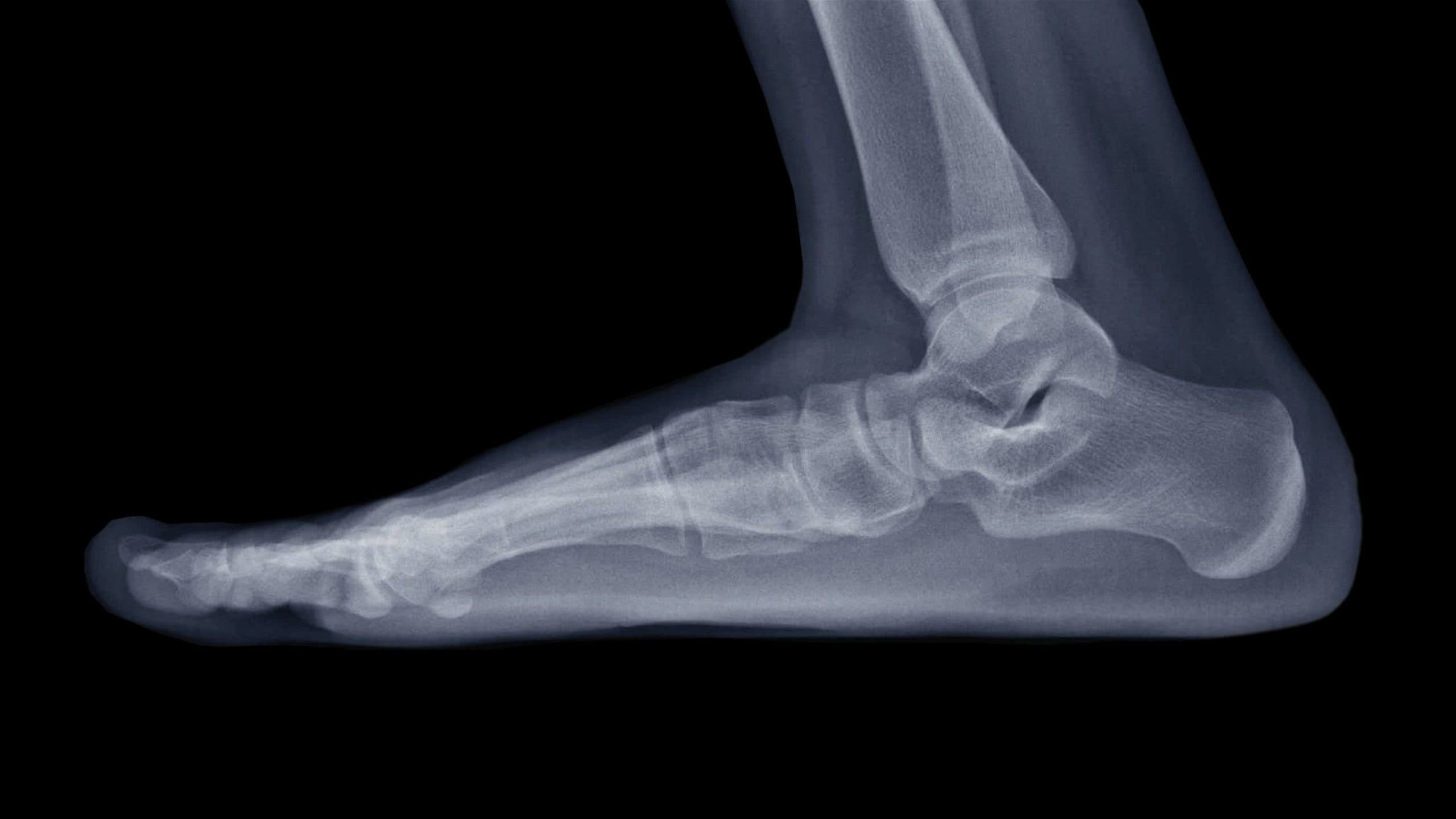 Film X-ray foot radiograph show Flat foot deformity (pes planus