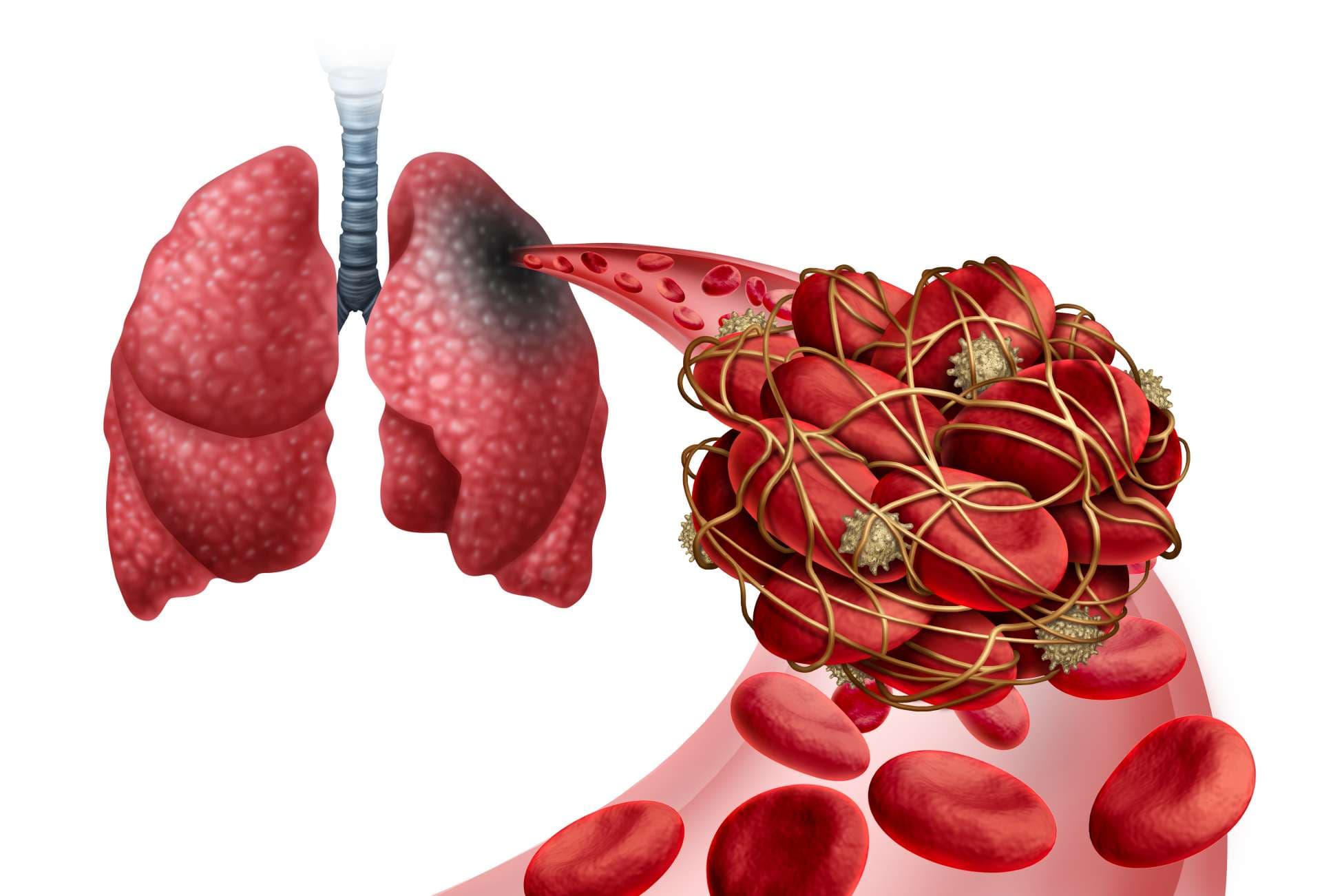 Lungenembolie mit einem Blutgerinnsel als Krankheit mit einer Verstopfung einer Arterie in der Lunge mit 3D-Illustrationselementen.