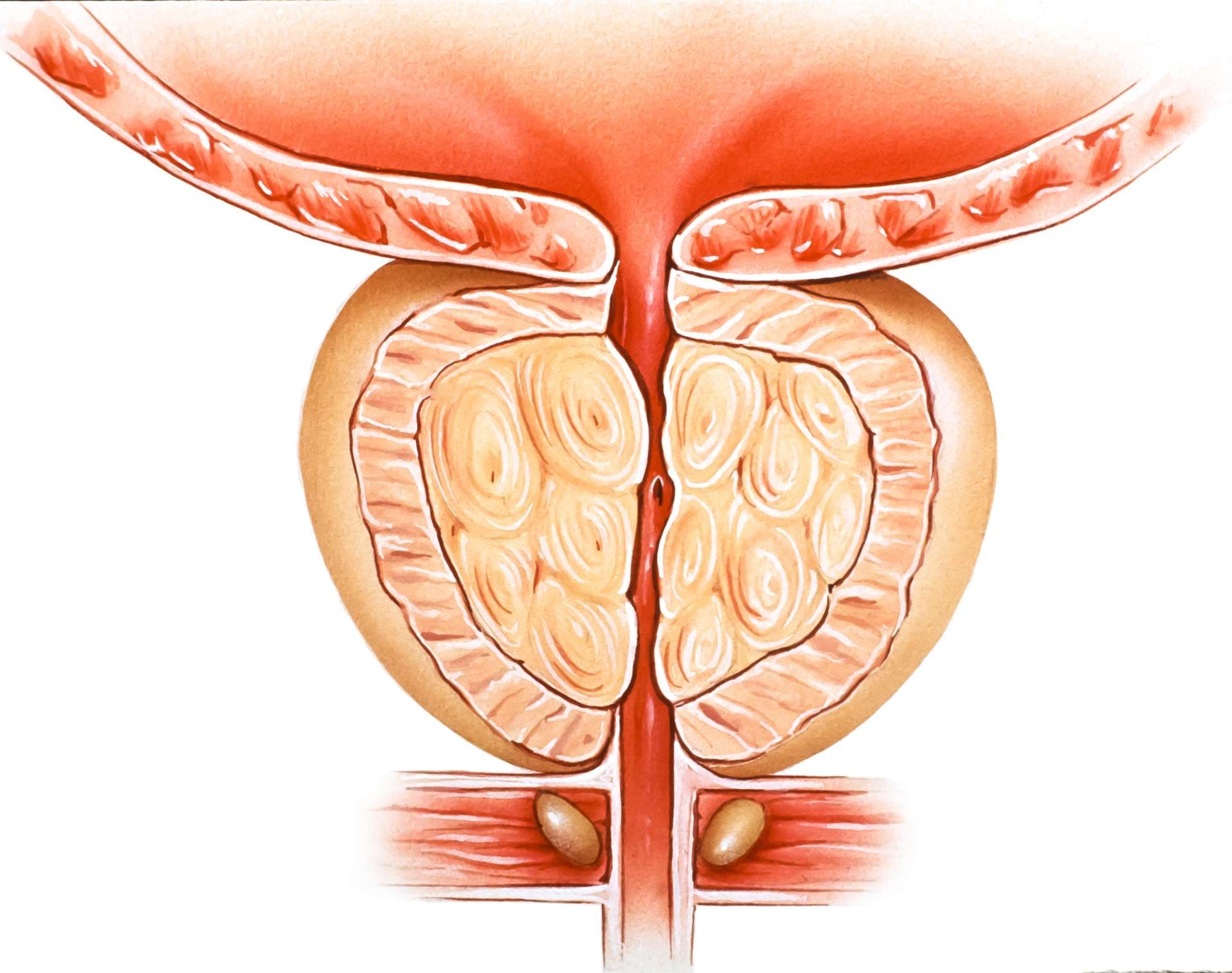 Enlarged prostate: Called benign prostatic hypertrophy or BPH, prostate growth affects virtually all men over 50. Symptoms of difficult urination tend to increase with age. Enlarged prostate is caused primarily by meat based and processed food diets. Plant based diet, medicines or surgery can treat BPH.