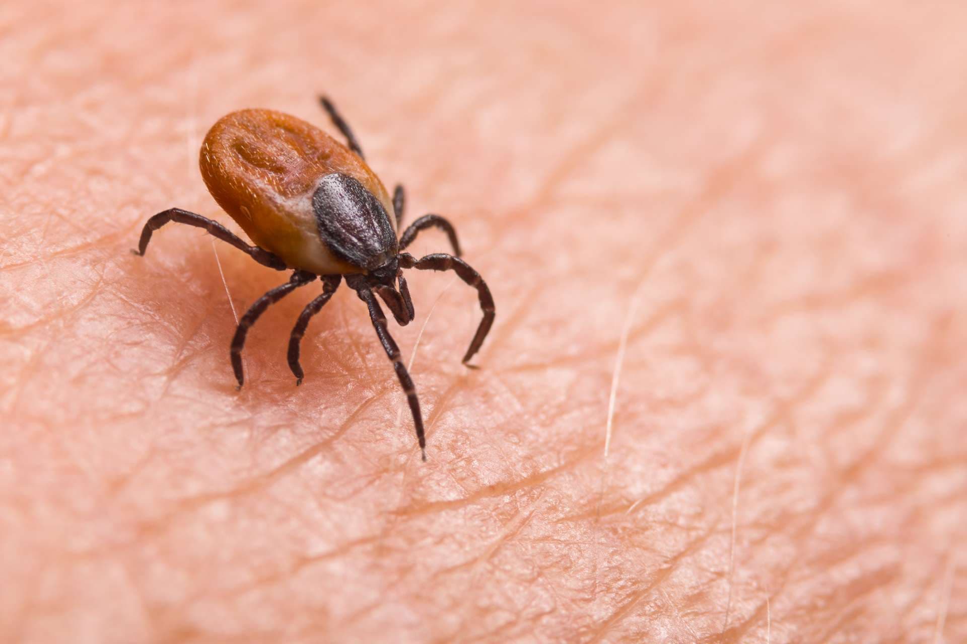 Infizierte weibliche Hirschzecke auf behaarter menschlicher Haut. Ixodes ricinus. Gefährliches Milbendetail. Akarus. Infektiöse Borreliose