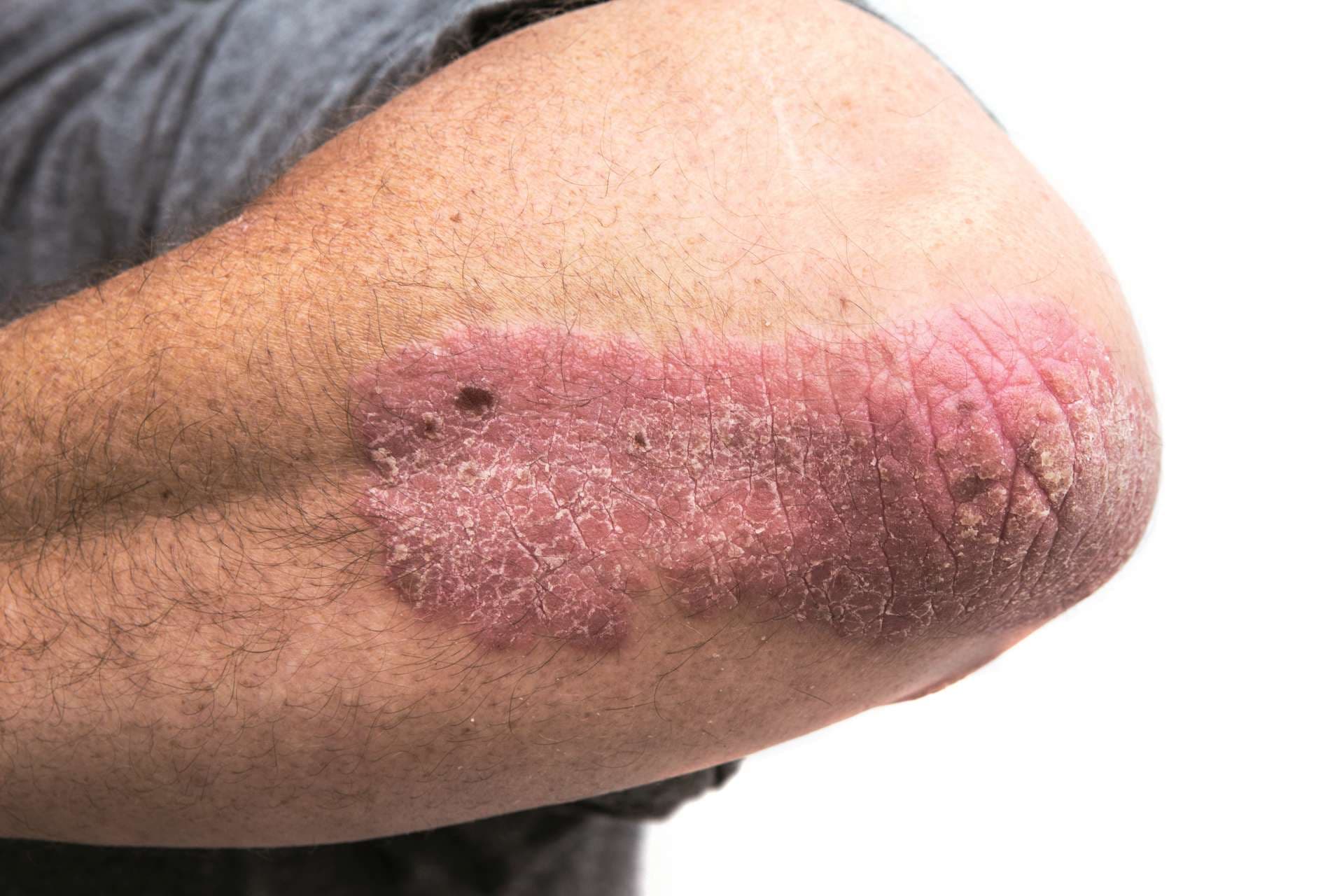Psoriasis am Ellbogen eines Mannes mittleren Alters. Nicht isoliert.