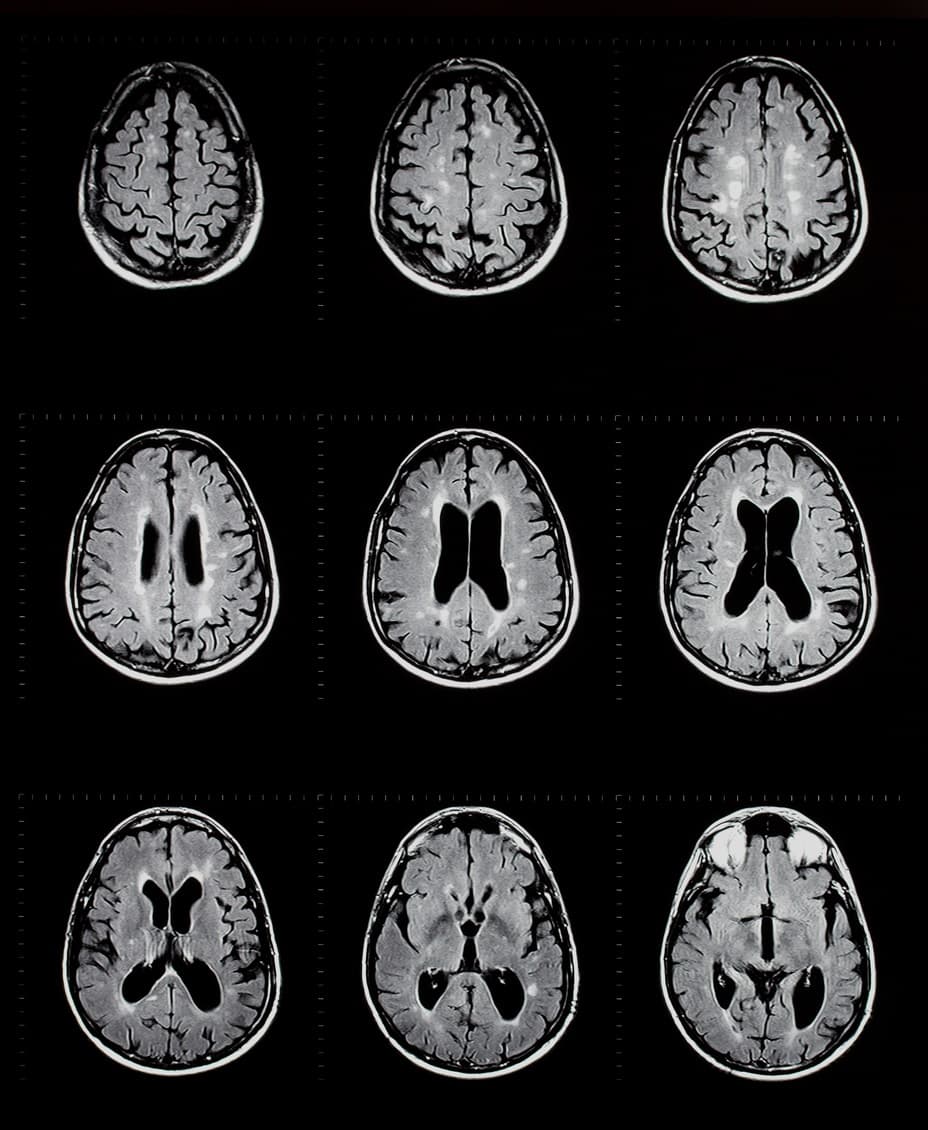 MRT-Untersuchung des menschlichen Gehirns mit Multiple-Sklerose-Plaques