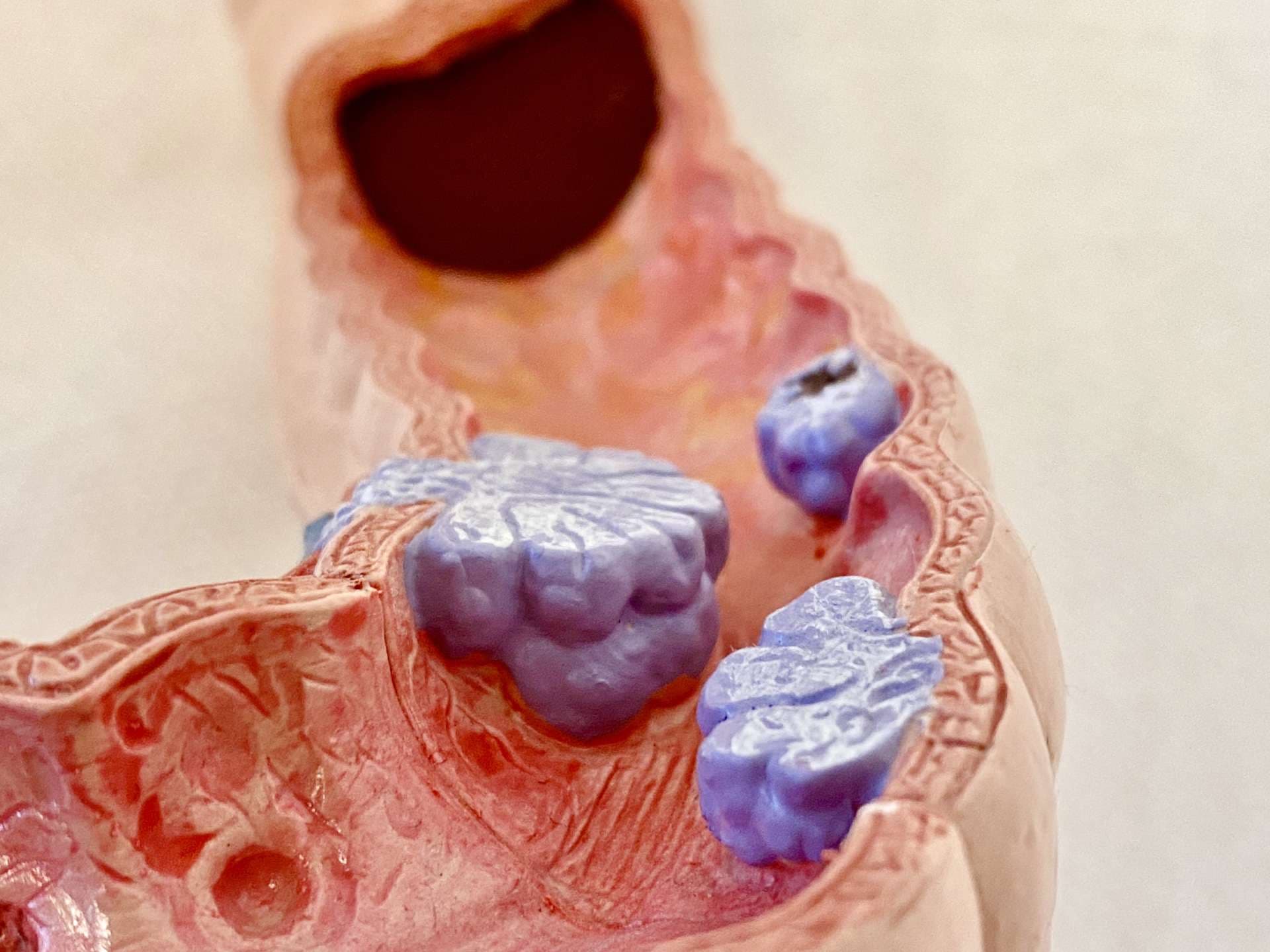 Anatomisches Modell von Darmkrebs