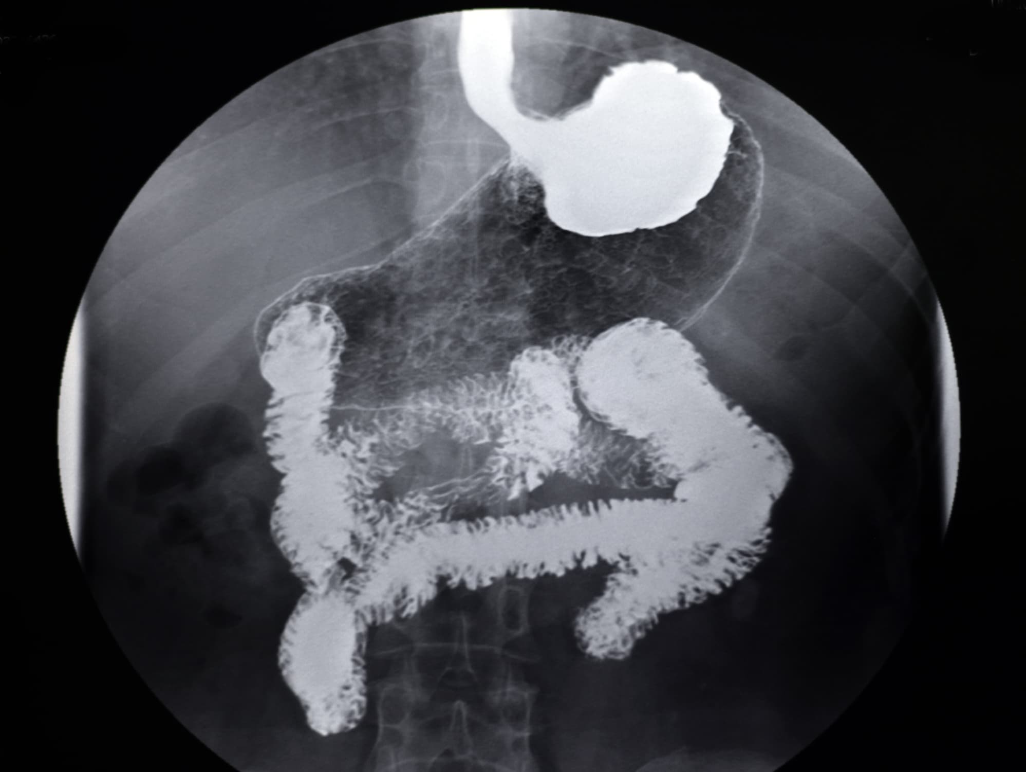 Röntgen-Magen-Darm-Angiographie-Bild des menschlichen Magens,