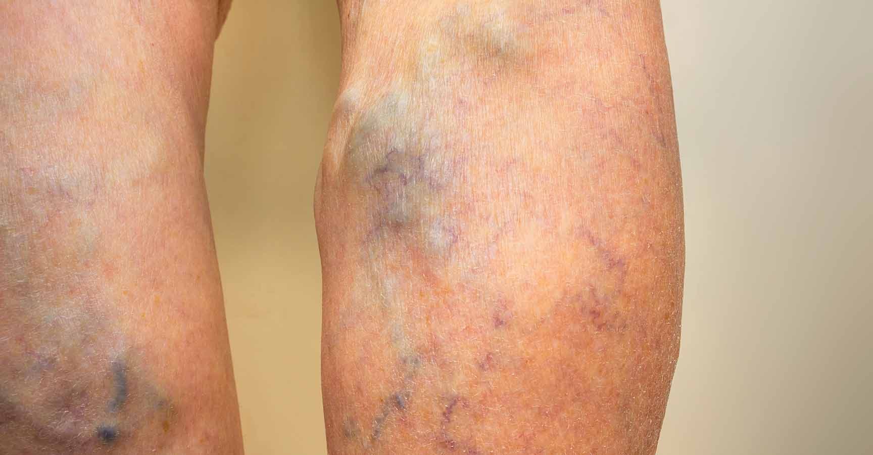 Varicose veins on a female senior leg close up