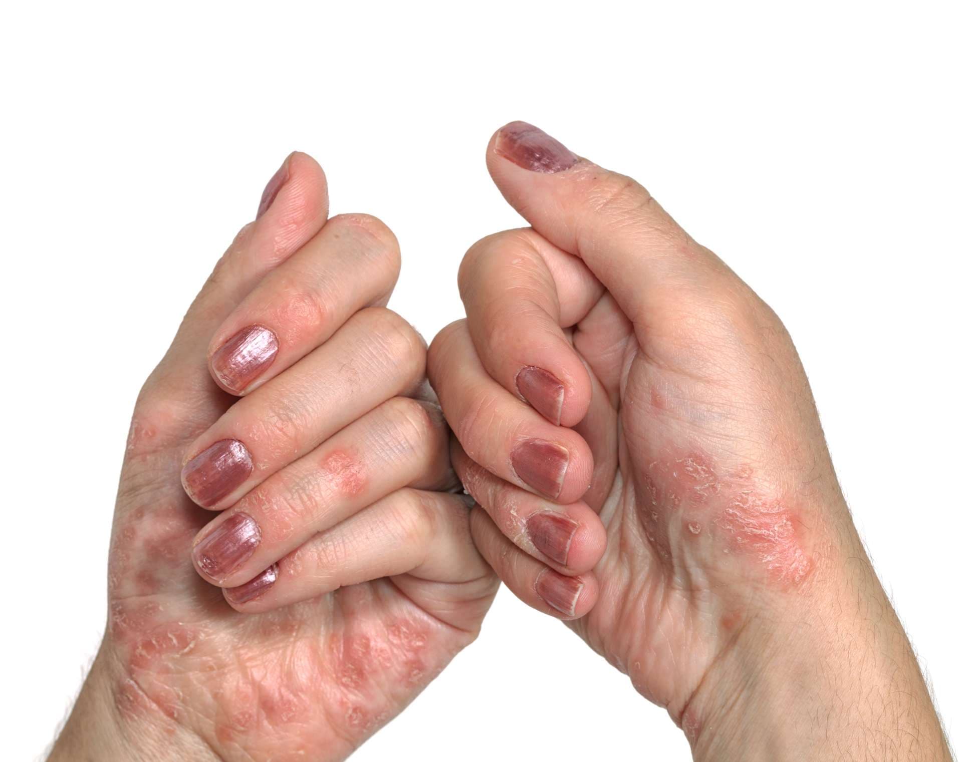 Psoriasis, dermatologische Erkrankungen.