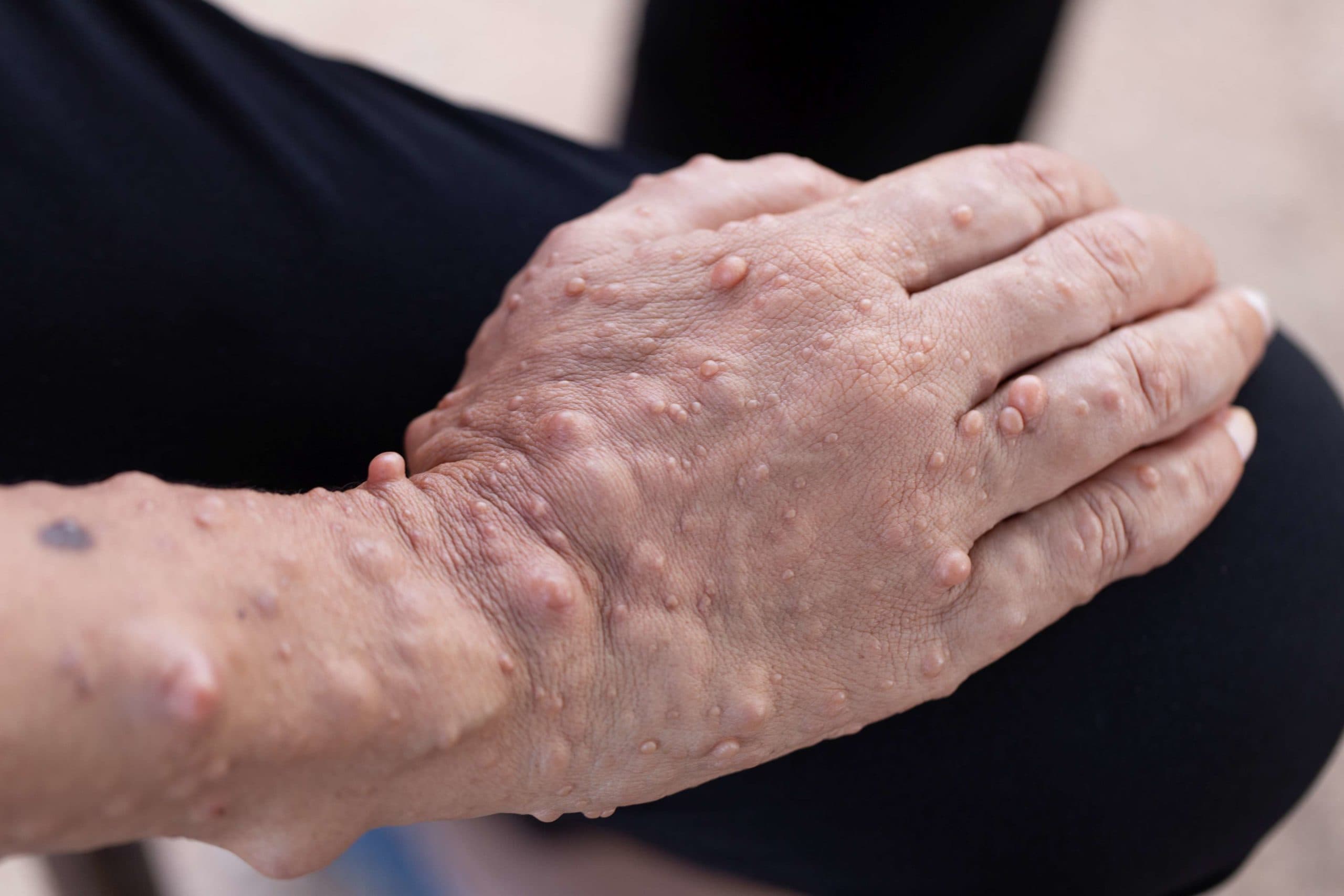 Neurofibromatose (NF) ist eine Erkrankung, bei der Tumore wachsen. Zu den Symptomen gehören hellbraune Flecken auf der Haut.