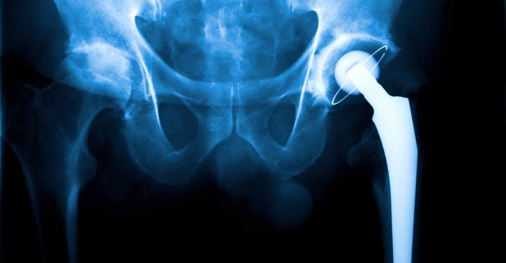 Real X-ray of a Arthroplasty of the hip joint. (Abbreviation: HTP or H-TEP)