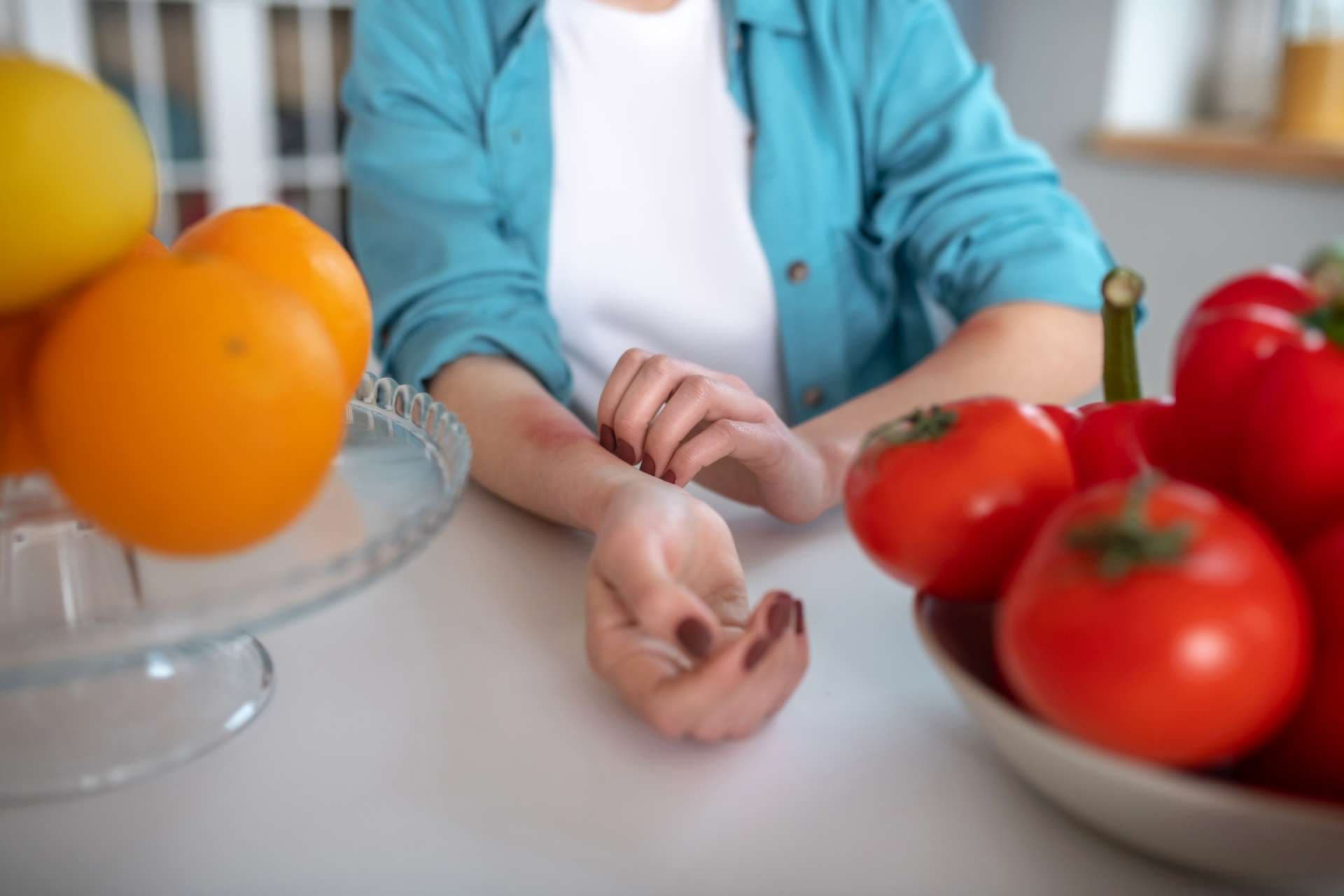 Zu Tomaten und Orangen alergisch sein. Frau, die Produkte isst, die eine Alergie verursachen