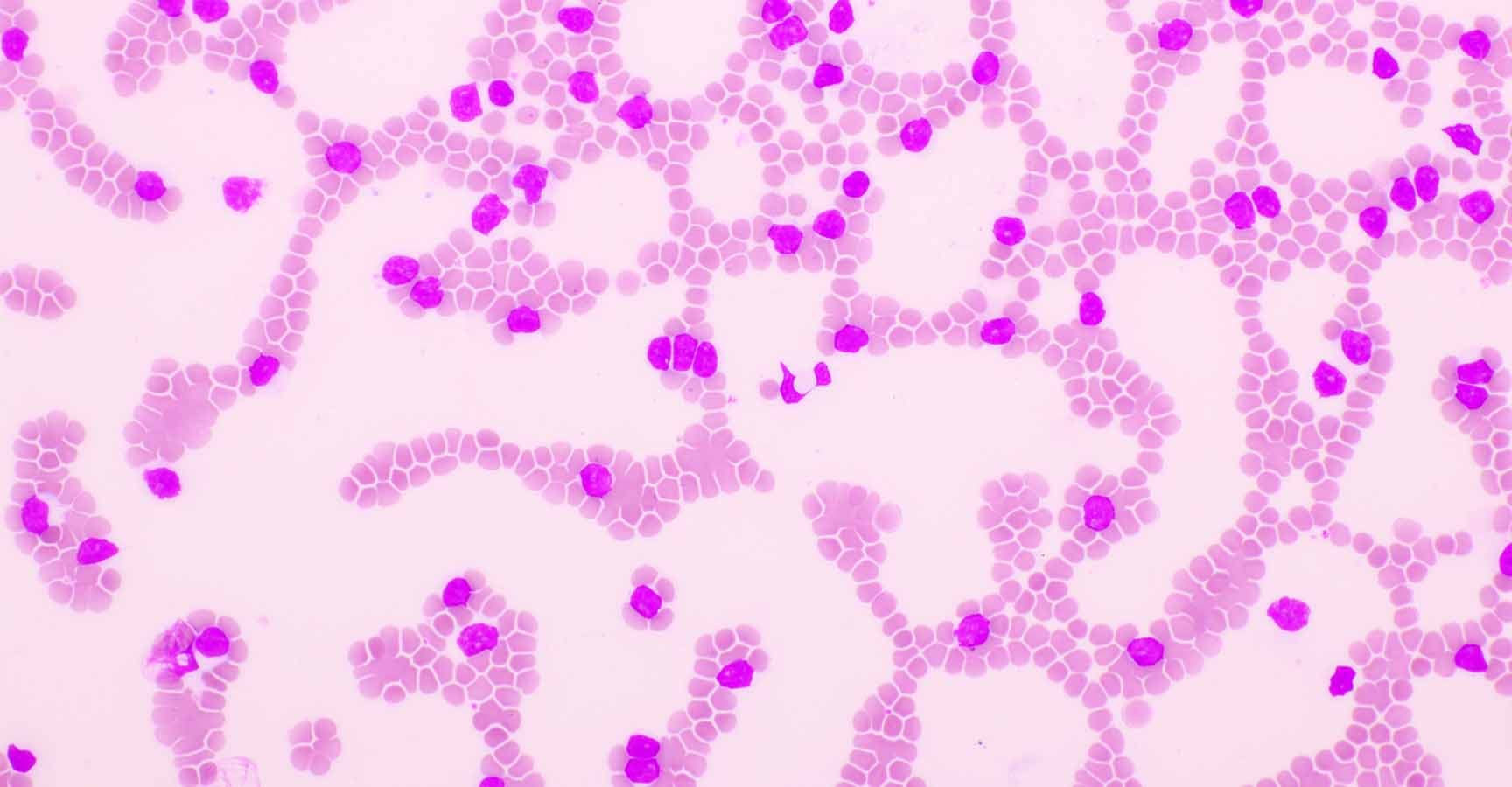 Picture of acute lymphocytic leukemia or ALL cells in blood smear, analyze by microscope, 400x