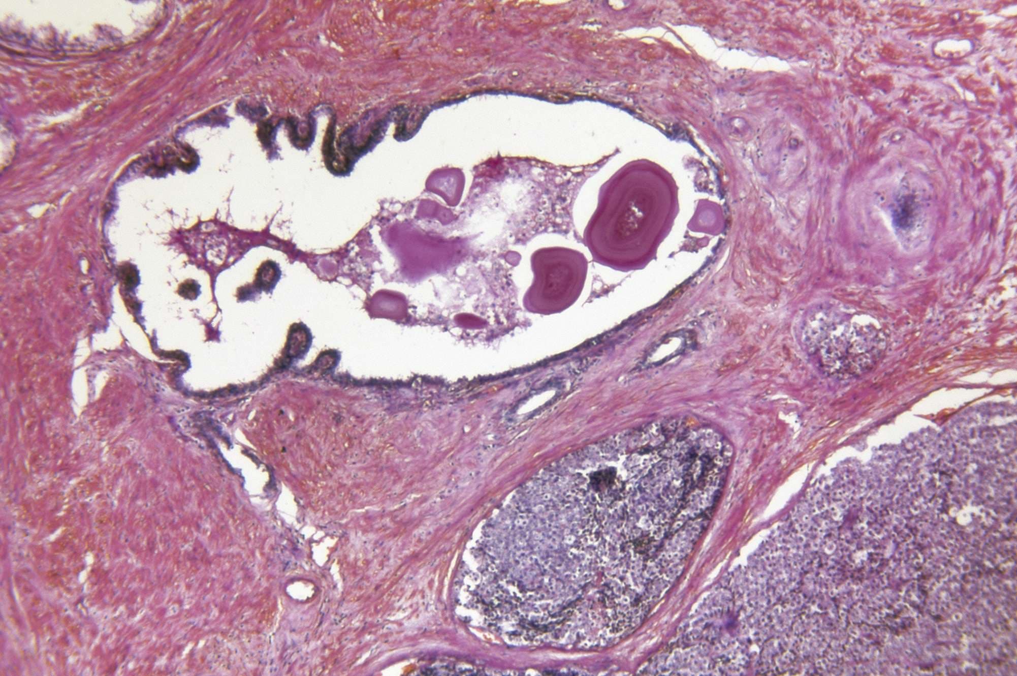 Prostata Adenocarcinoma