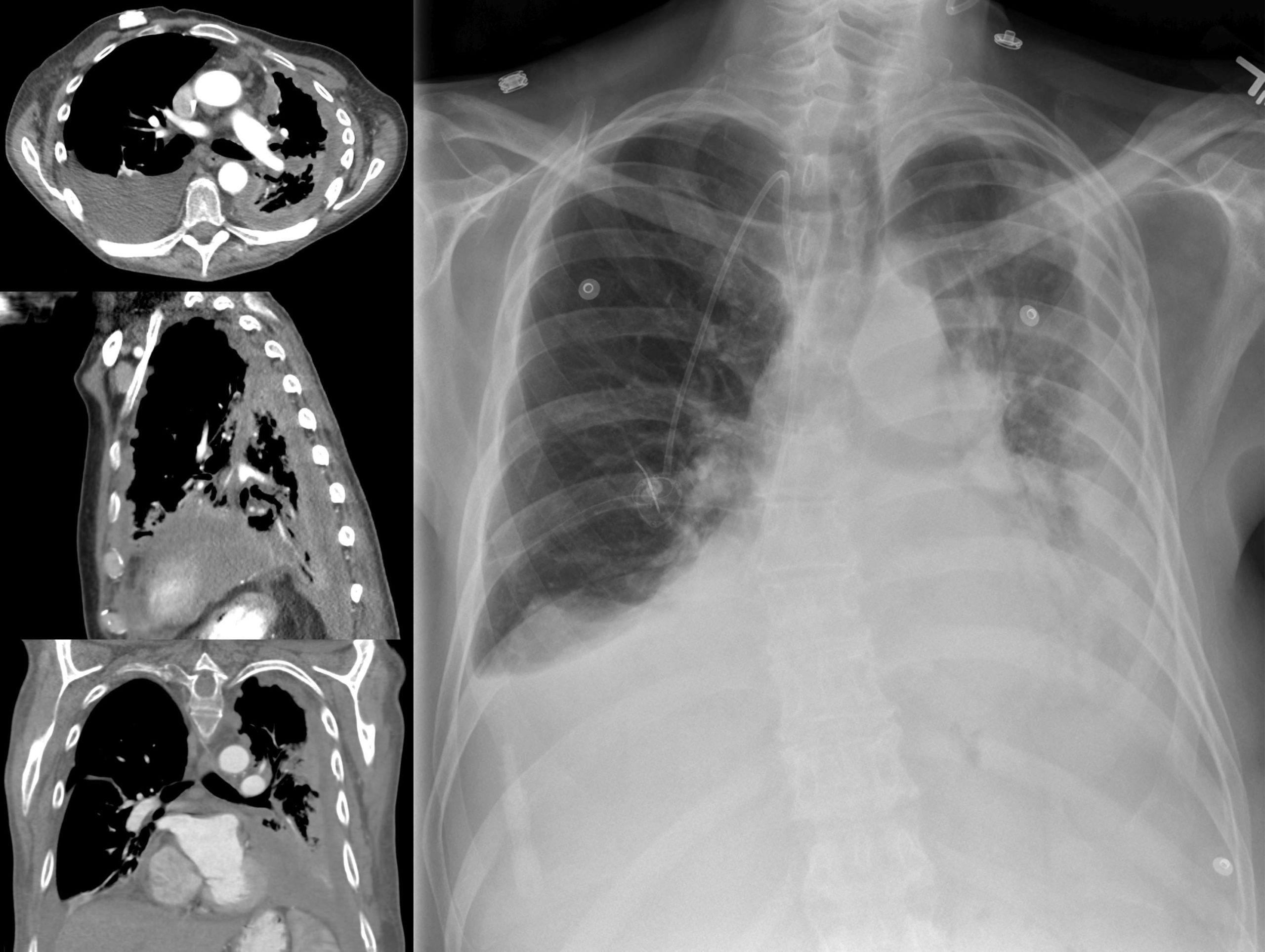 Fortgeschrittenes Mesotheliom aufgrund von Asbestexposition bei CT und Röntgen