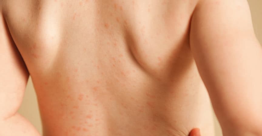 Farbfoto eines zweijährigen Mädchens mit einem Hautausschlag aufgrund einer allergischen Reaktion auf das Antibiotikum Amoxicillin.