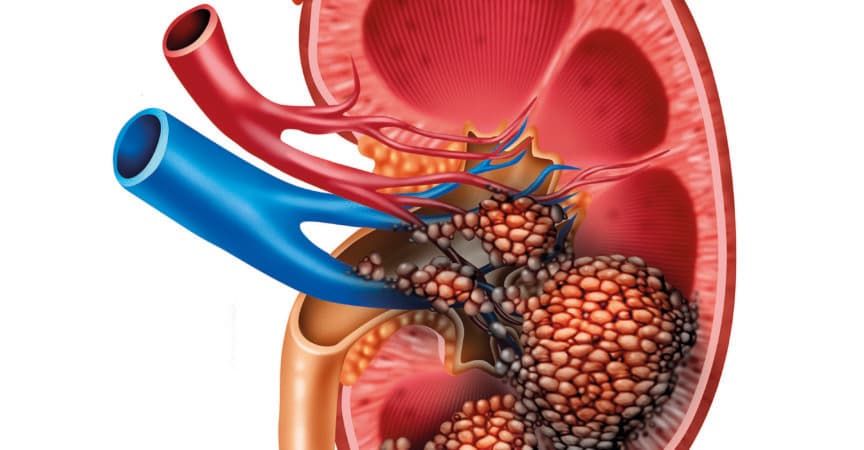 Anatomie des menschlichen Nierenkrebses